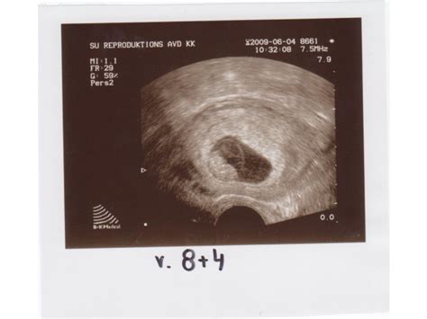 Gravid v 8 missfallsrisk